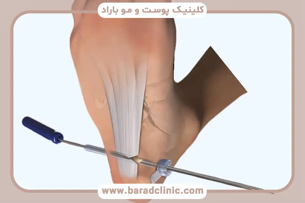 پی‌آر‌پی برای خار پاشنه