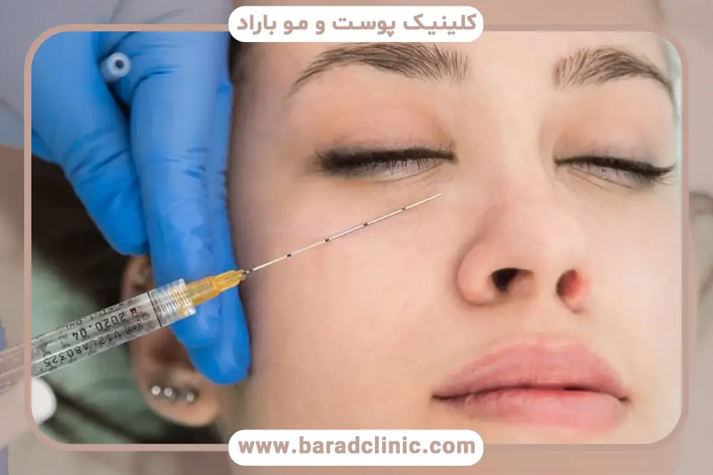 ماندگاری مزوتراپی دور چشم