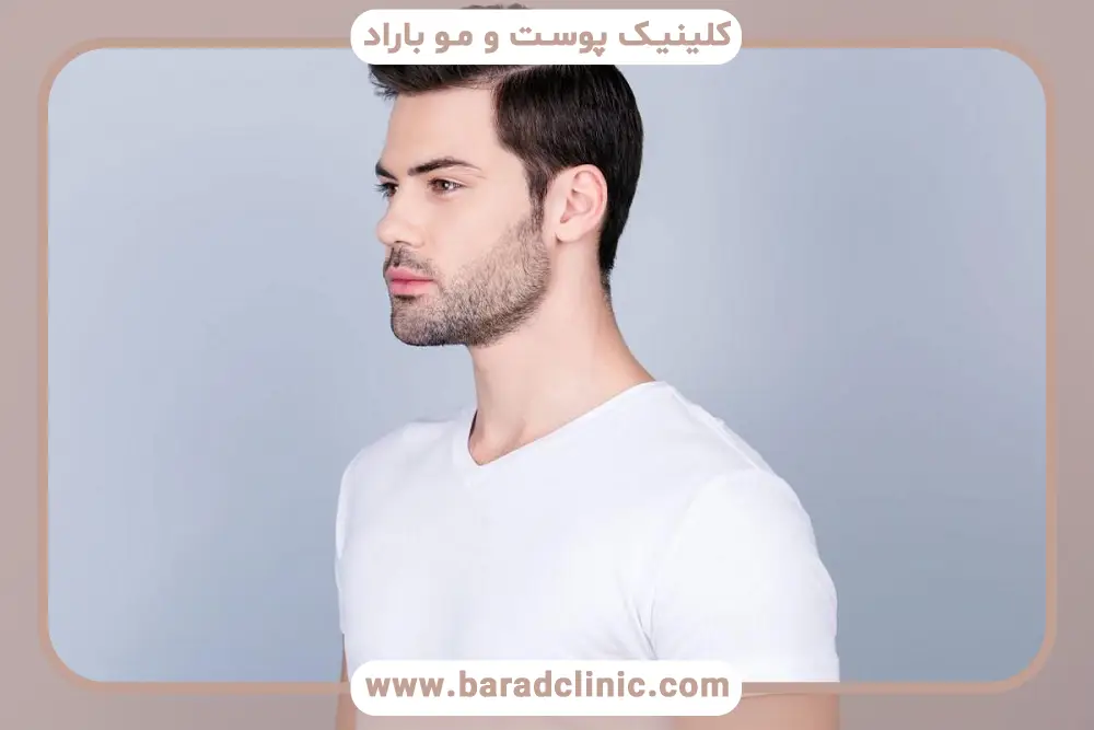 کاشت مو به روش sut در تهران