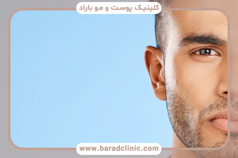 ژنتیک و رشد ریش