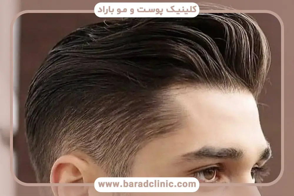 نظرات مردم در مورد کاشت مو به روش sut