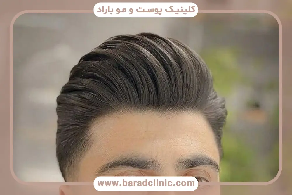 کاشت مو مجدد