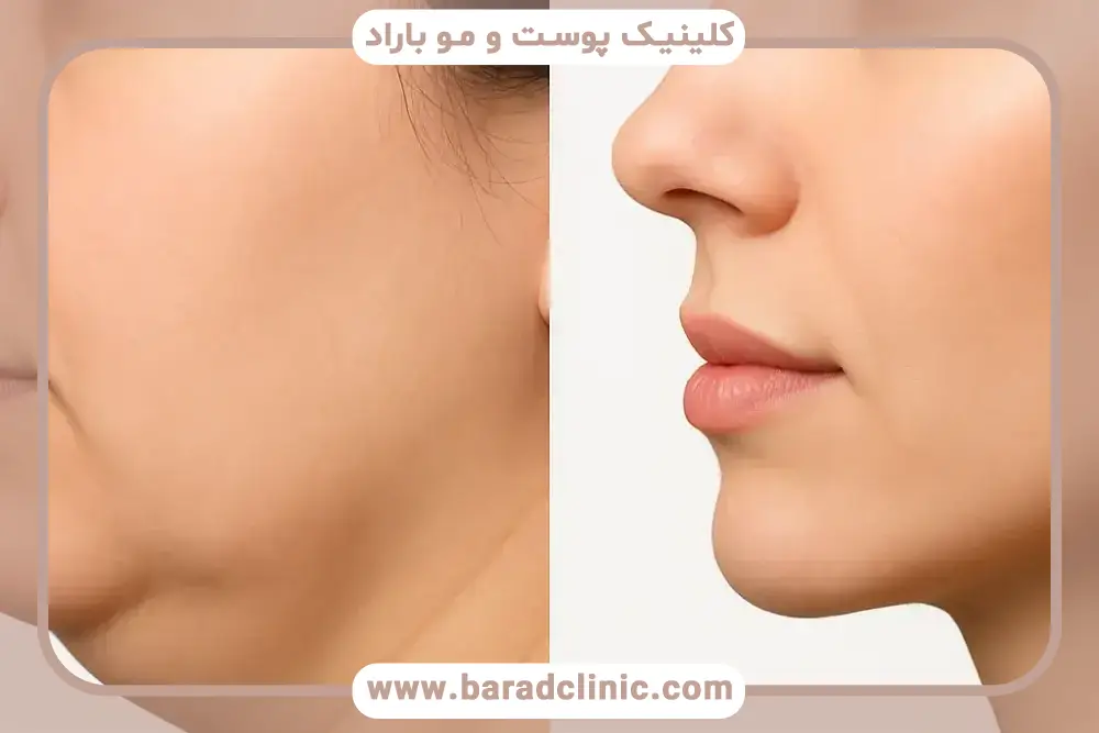 هزینه ی مزوتراپی غبغب