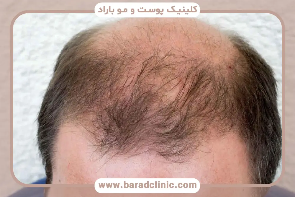 تفاوت ریزش مو موقت و دائمی