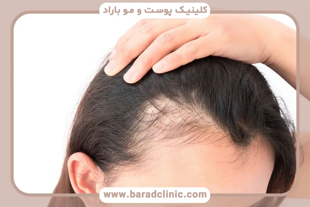 طاسی زنانه (الگوی لودویگ)