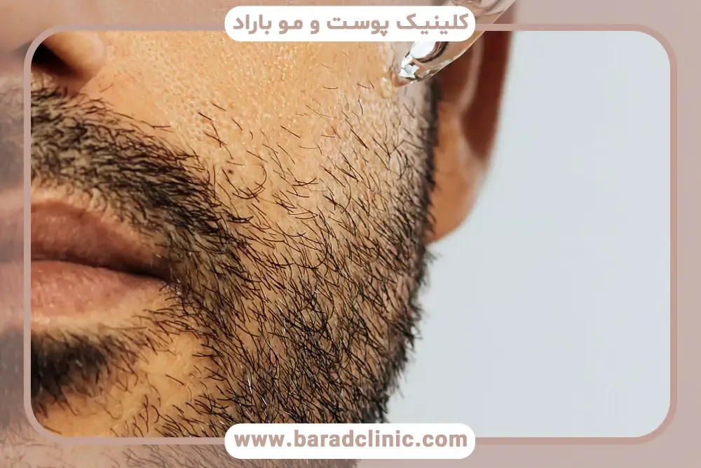 تیروئید و ریش