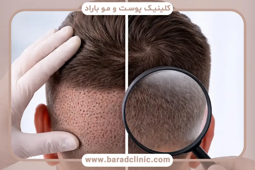 عکس پشت سر بعد از کاشت مو