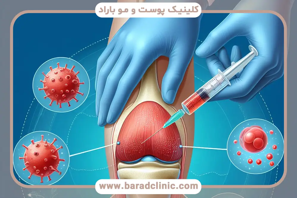پی‌آر‌پی برای آسیب‌های اسکلتی عضلانی