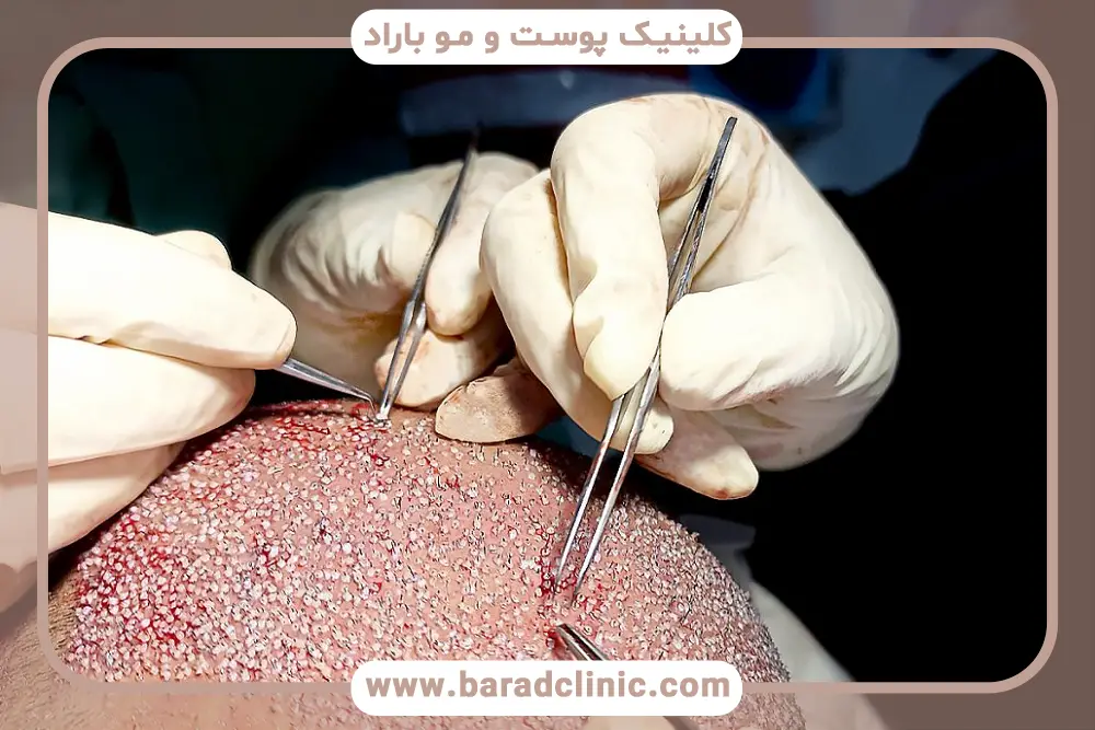 تفاوت کاشت مو با نیدل فاین و نیدل معمولی