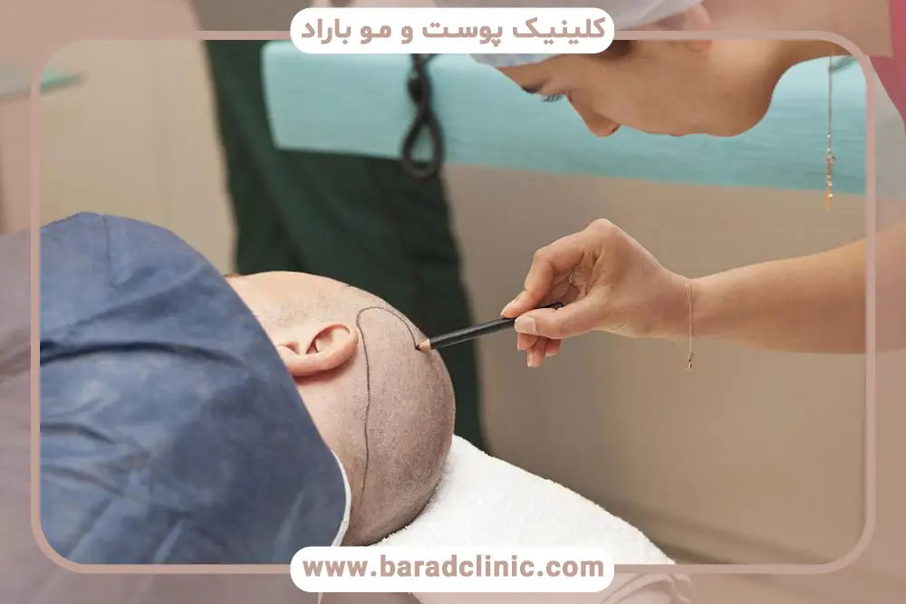 عوارض دائمی کاشت مو با نیدل چیست؟