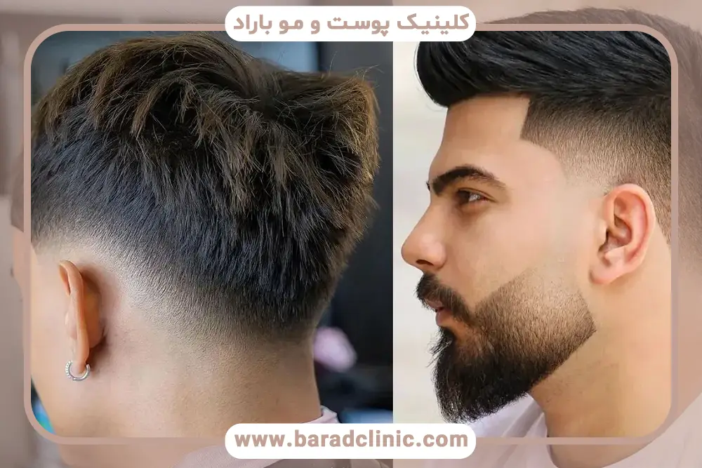 نیدل کلون (Needle Clone) در کاشت مو