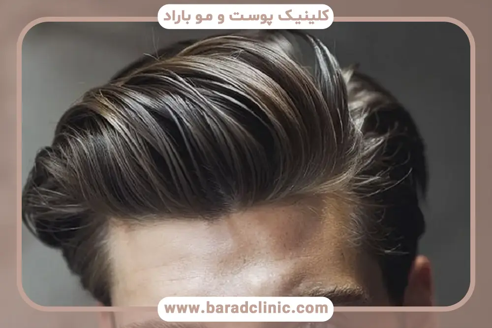 کاشت مو fci در ایران