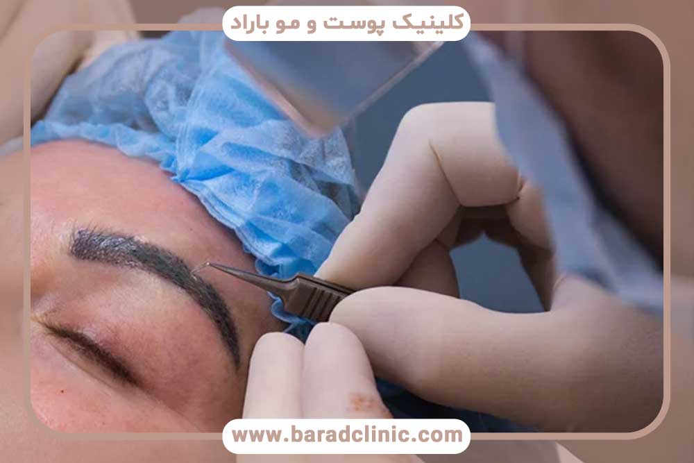 کاشت ابرو به روش DHI