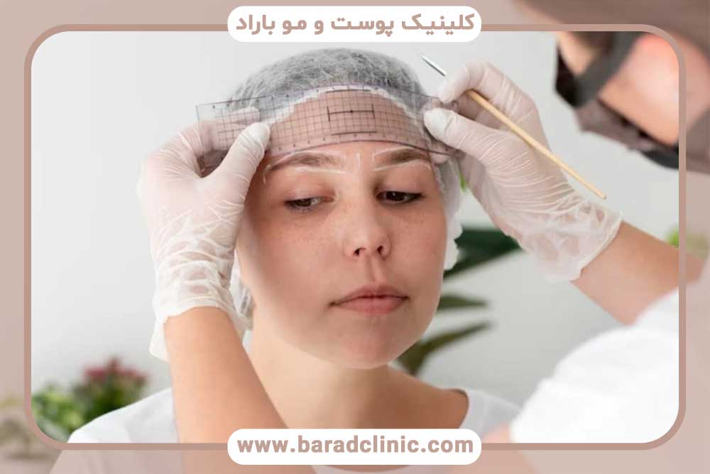 عمل میکرو کاشت ابرو