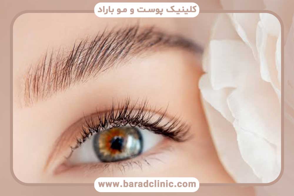 مزایا میکرو کاشت ابرو