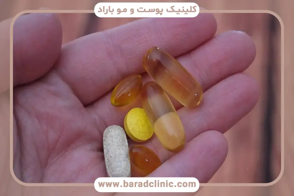 اهمیت مصرف بهترین قرص مکمل بعد از کاشت مو