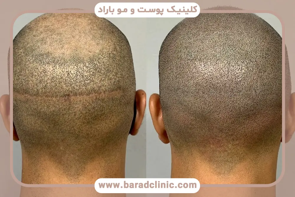 زمان شروع رشد موها بعد از کاشت