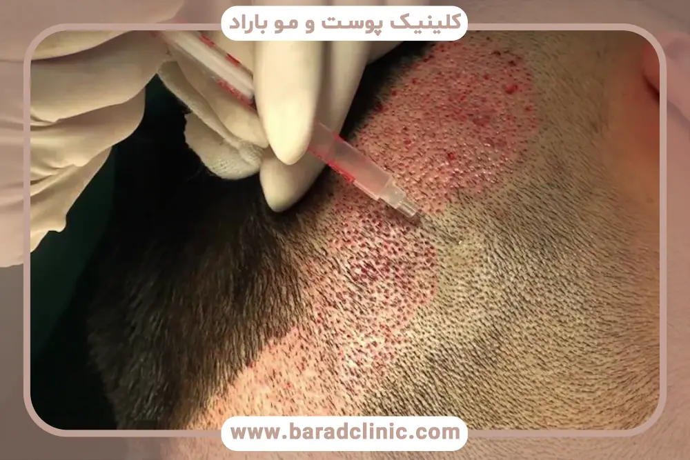 اهمیت مصرف بهترین مکمل بعد از کاشت مو 