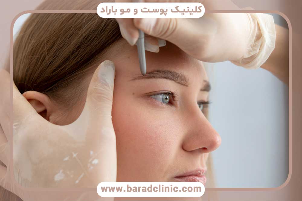 قیمت کاشت ابرو