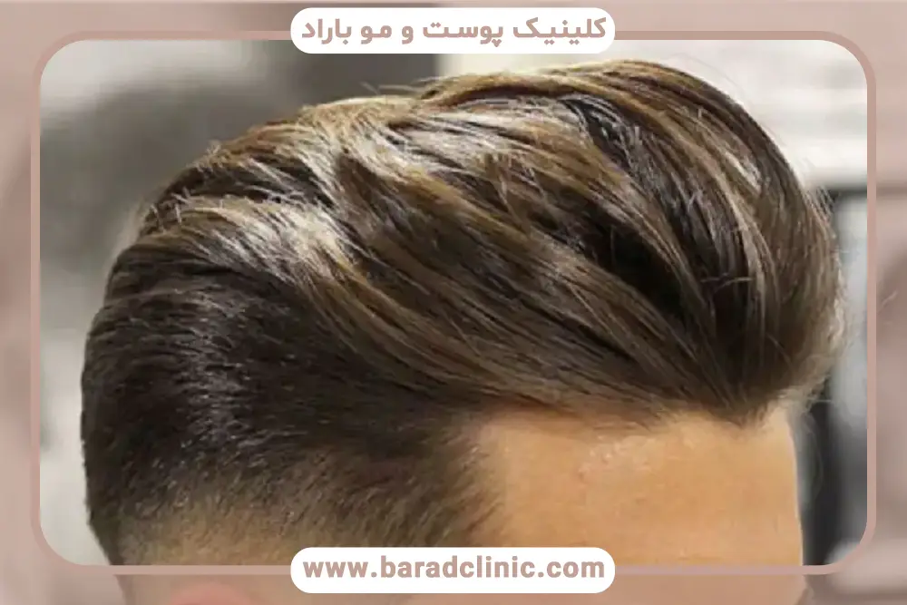 کاشت مو روش نیدل پلاس چیست؟