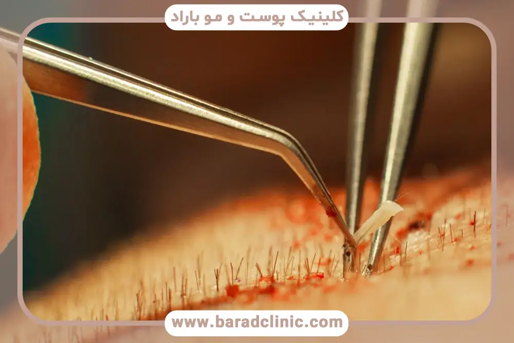 آشنایی با کاشت مو با نیدل بنفش آبی نارنجی 