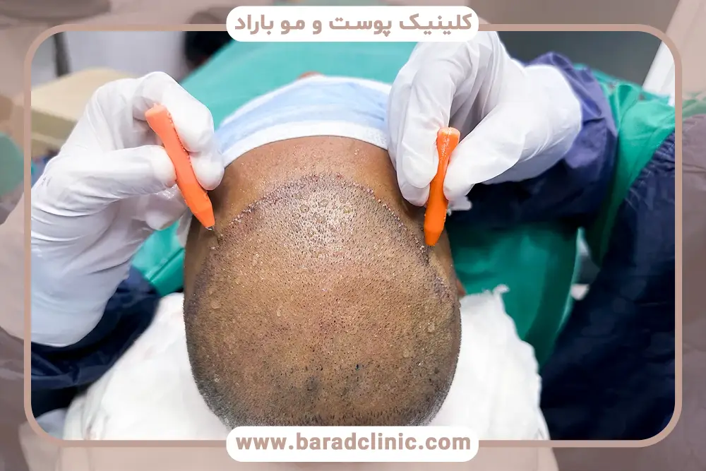 عوامل موثر بر هزینه کاشت مو با نیدل 