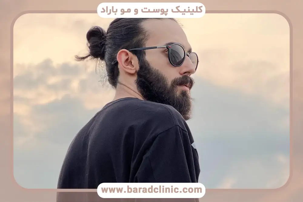 اهمیت تقویت مو بعد از کاشت 