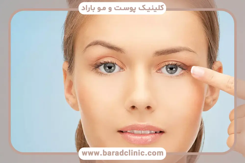 افتادگی پلک یک طرفه چیست؟