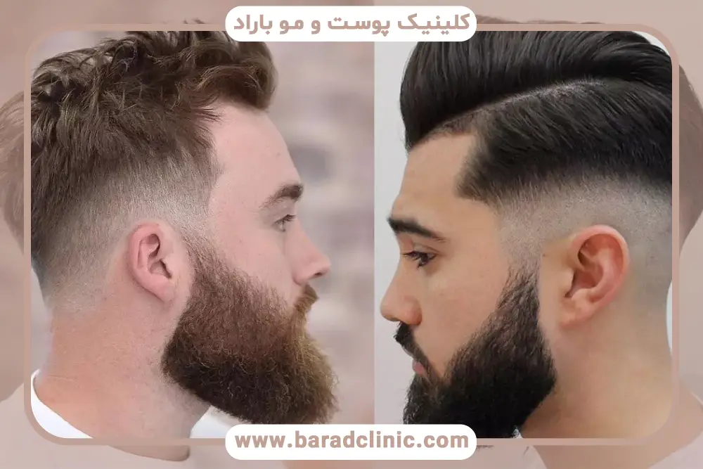 کاشت مو به روش sut در تهران چیست؟