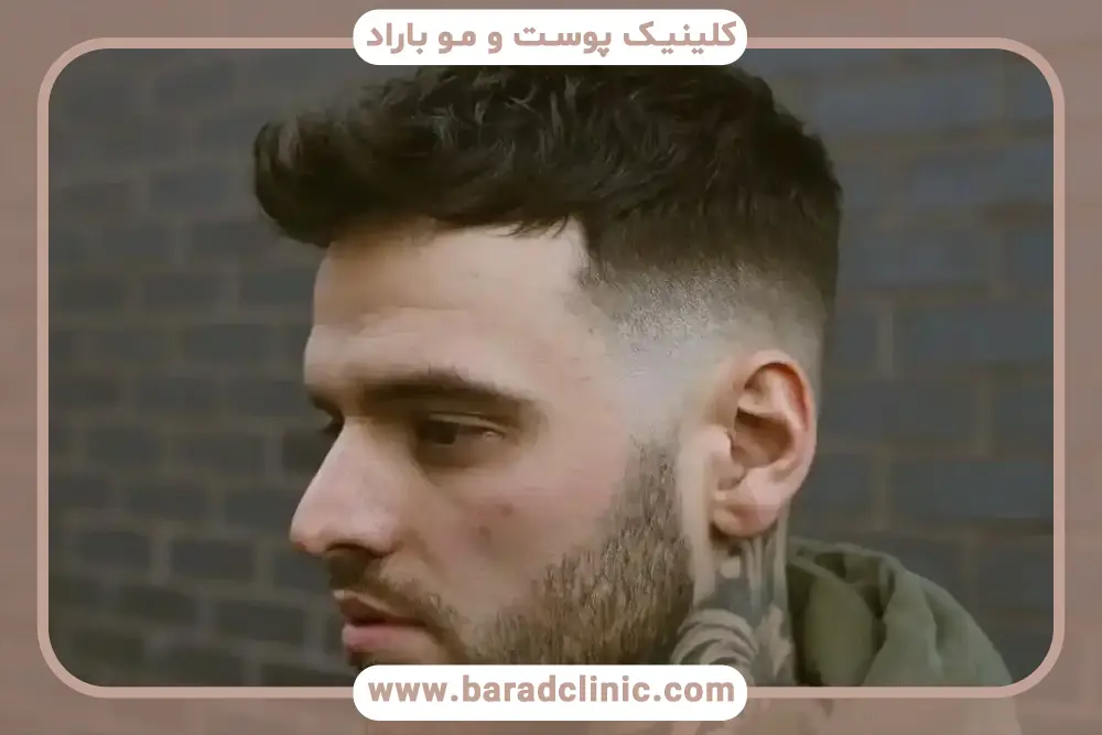 کاشت مو به روش sut با دستگاه اتوماتیک بدون جراحی چیست؟