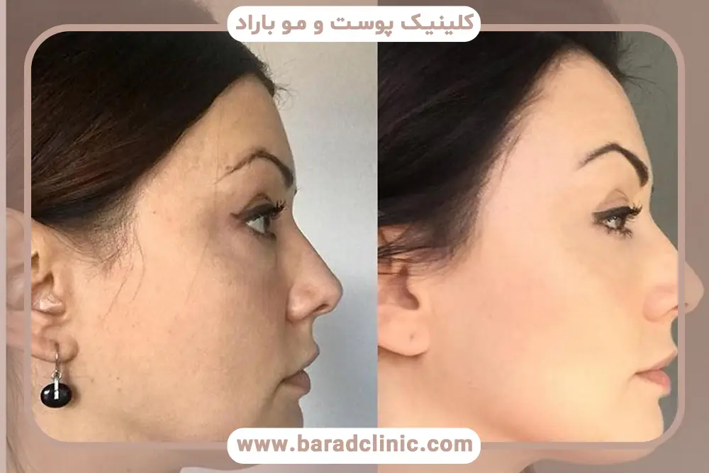 عوامل موثر بر هزینه ی مزوتراپی غبغب 