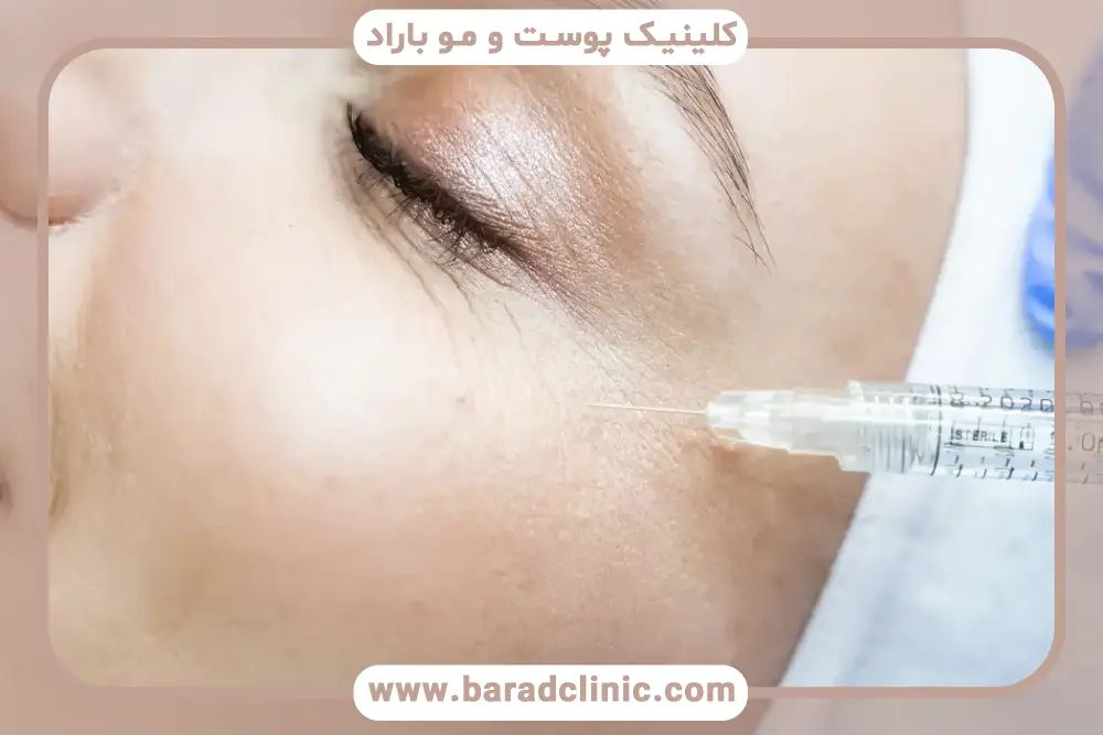 اهمیت مراقبت بعد از مزوتراپی زیر چشم