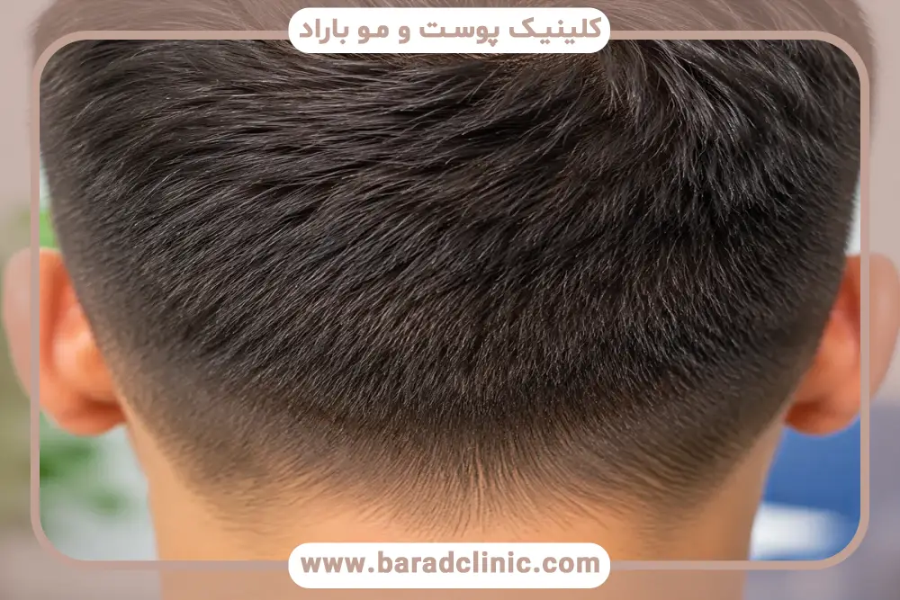 بررسی عکس پشت سر بعد از کاشت مو