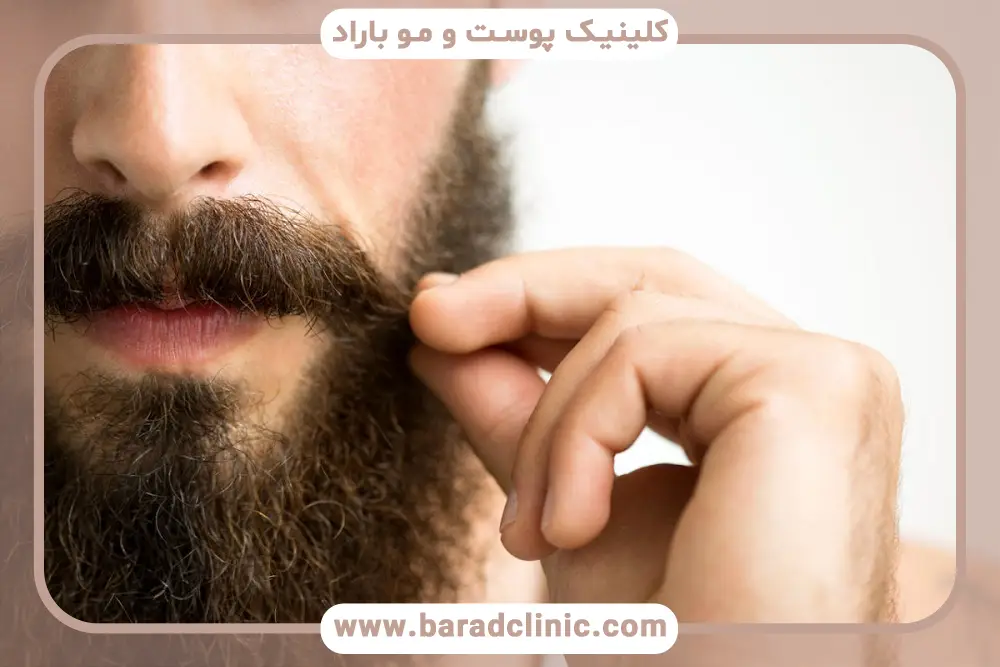 ماینوکسیدیل، بهترین دارو برای پرپشت شدن ریش