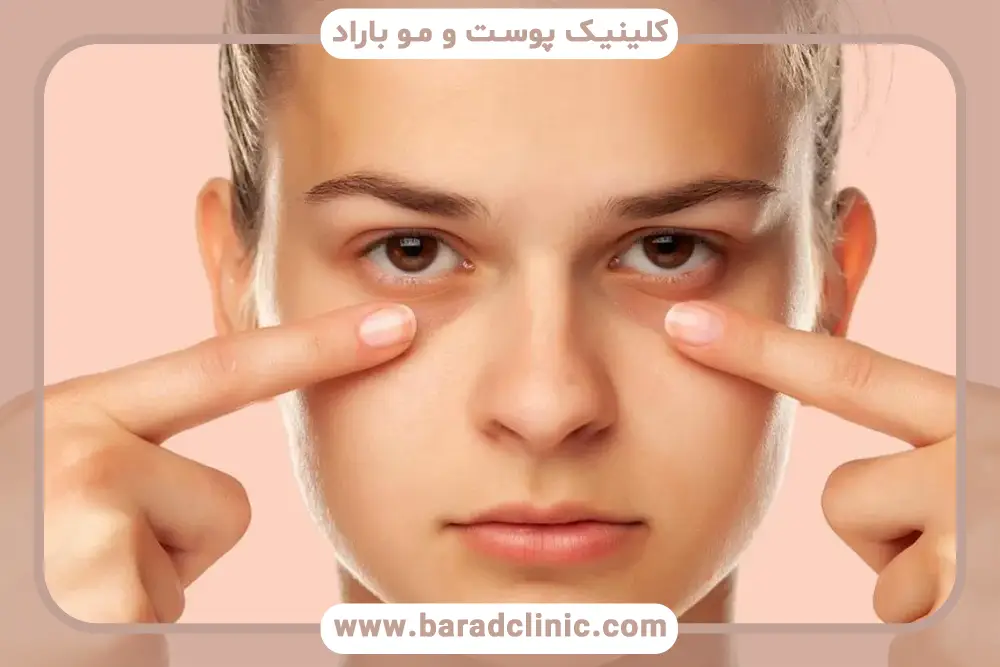 پف زیر چشم چیست؟ بررسی کلی