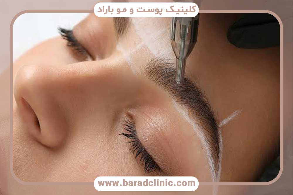 مزایای تکنیک DHI پیشرفته کاشت ابرو