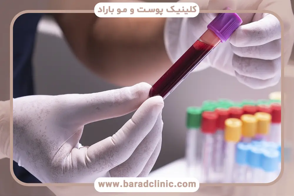 انعقاد خون از آزمایش های لازم قبل از کاشت ریش