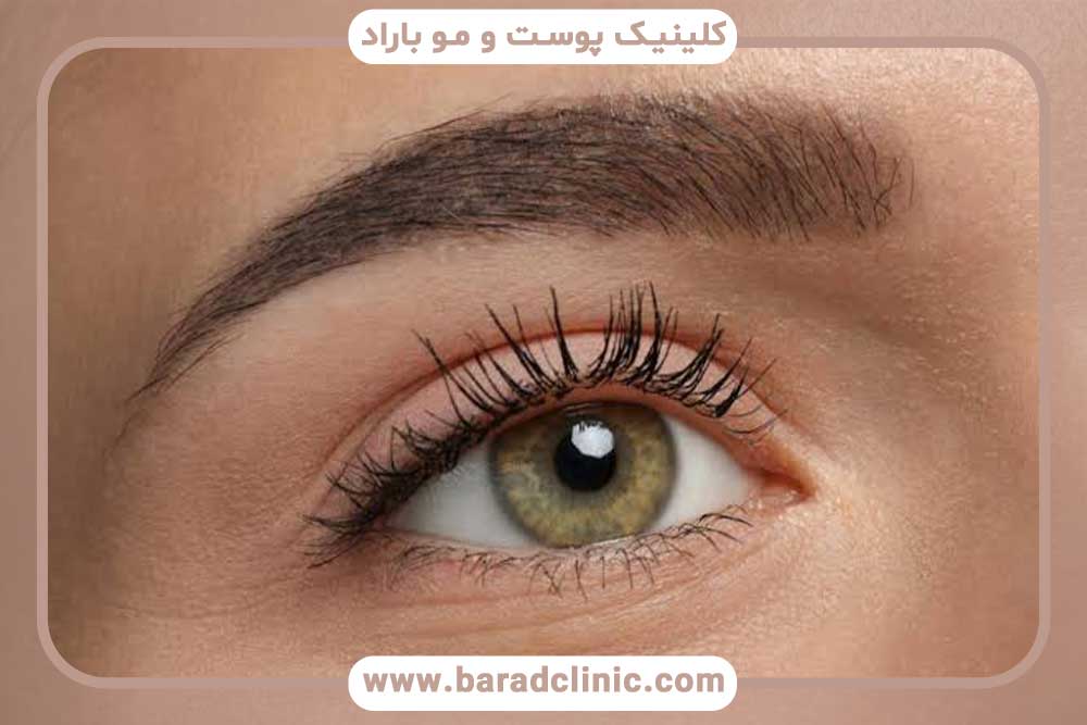 محدودیت‌های میکرو کاشت ابرو
