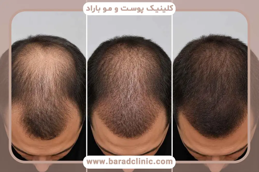 مراحل رشد موها بعد از کاشت 