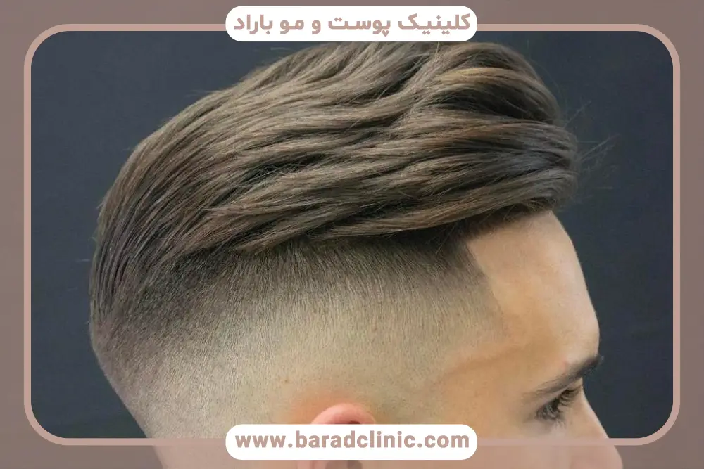 مراحل کاشت مو با نیدل 