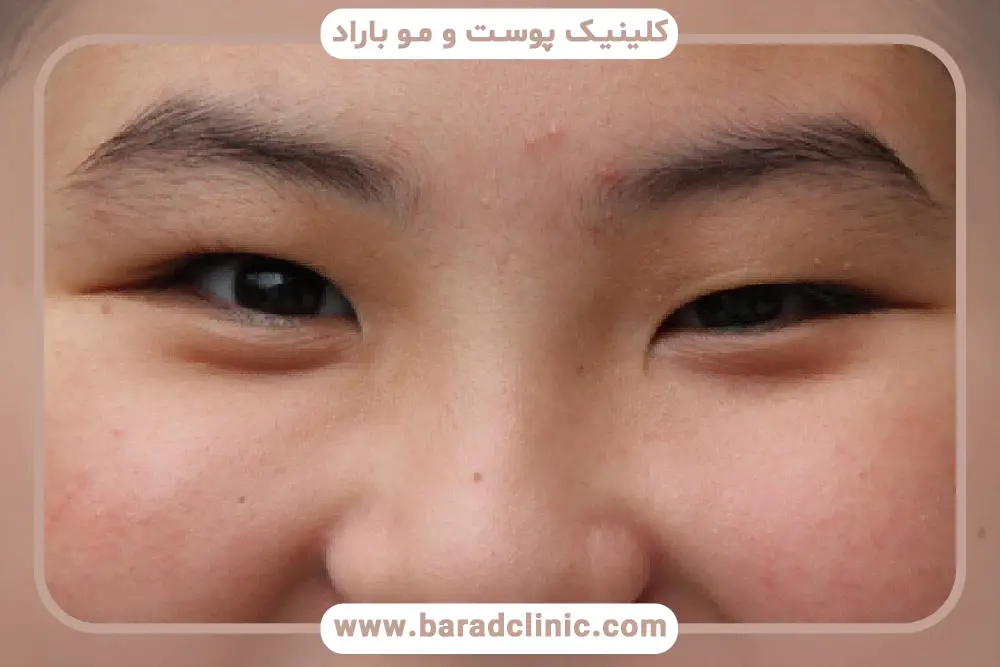 علائم پتوز مادرزادی پلک 