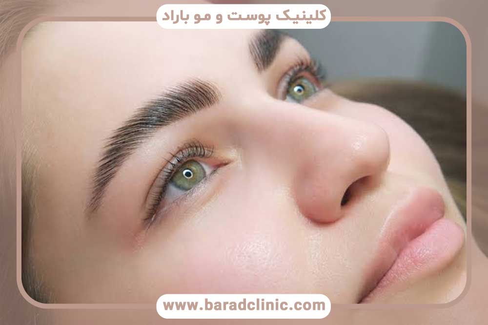 کاشت ابرو بعد از یک سال