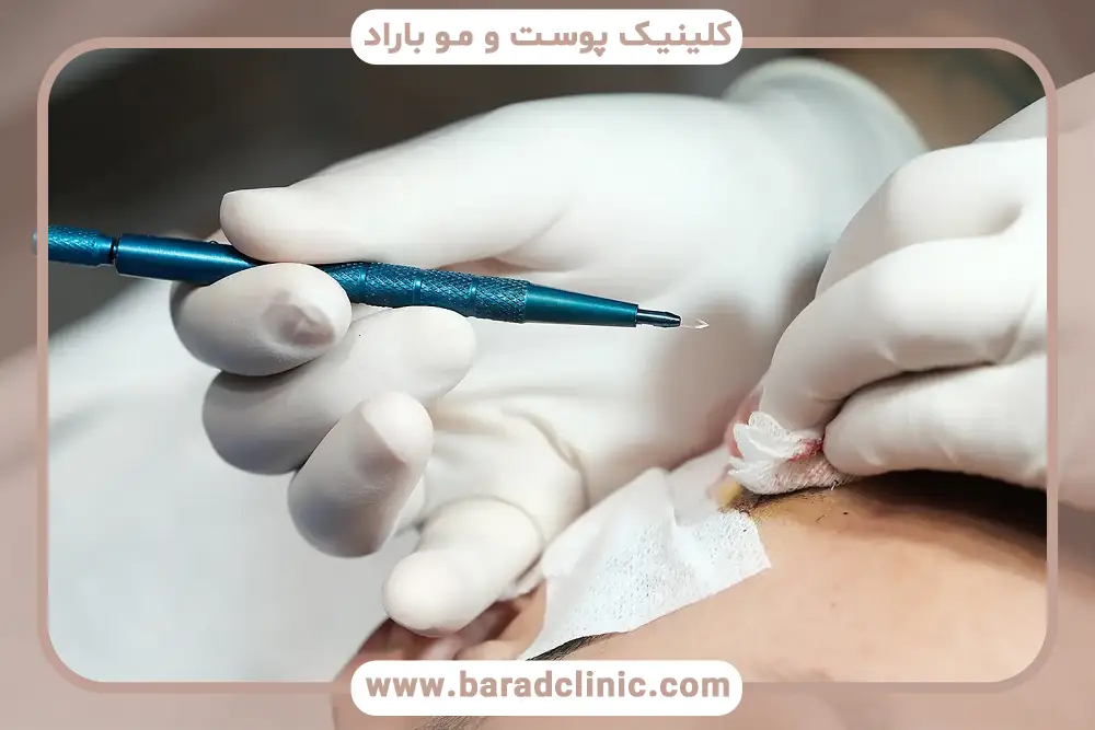 تاثیر رنگ نیدل روی دقت و ظرافت