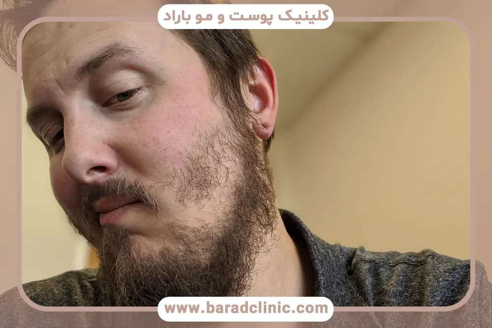 چرا ریشم در نمی آید؟ تاثیر هورمون‌ها