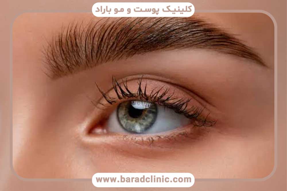 میکرو کاشت ابرو