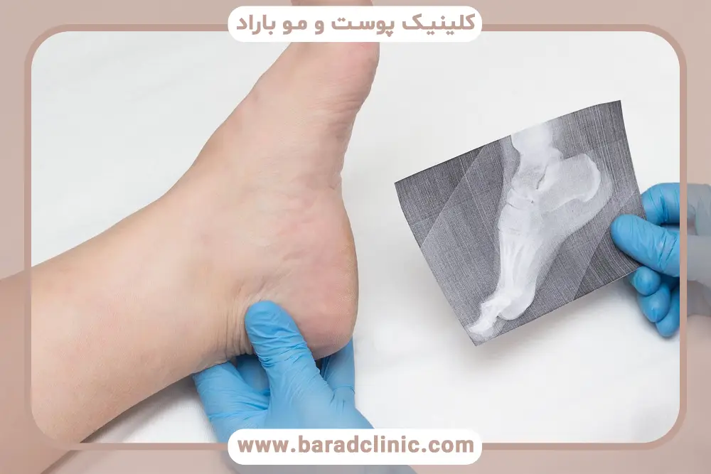 مزایای پی‌آر‌پی برای خار پاشنه 