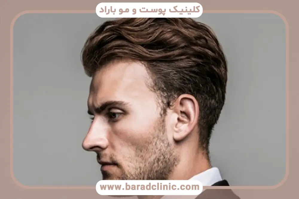 مکمل برای تقویت مو بعد از کاشت 