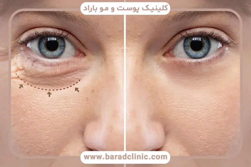میانگین ماندگاری مزوتراپی دور چشم 