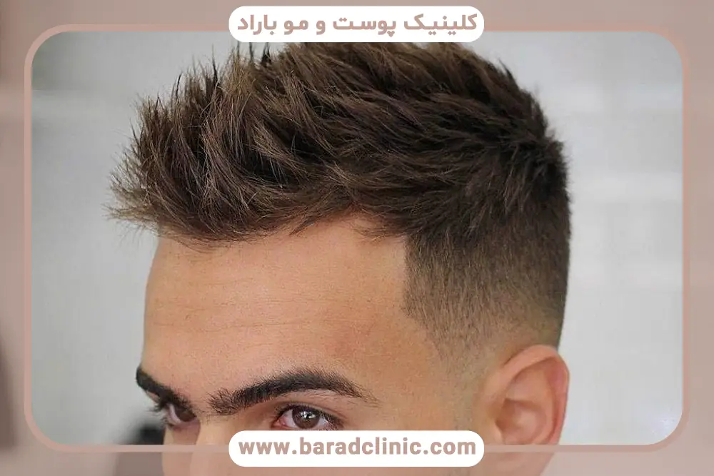 مزایای کاشت مو به روش sut با دستگاه اتوماتیک بدون جراحی