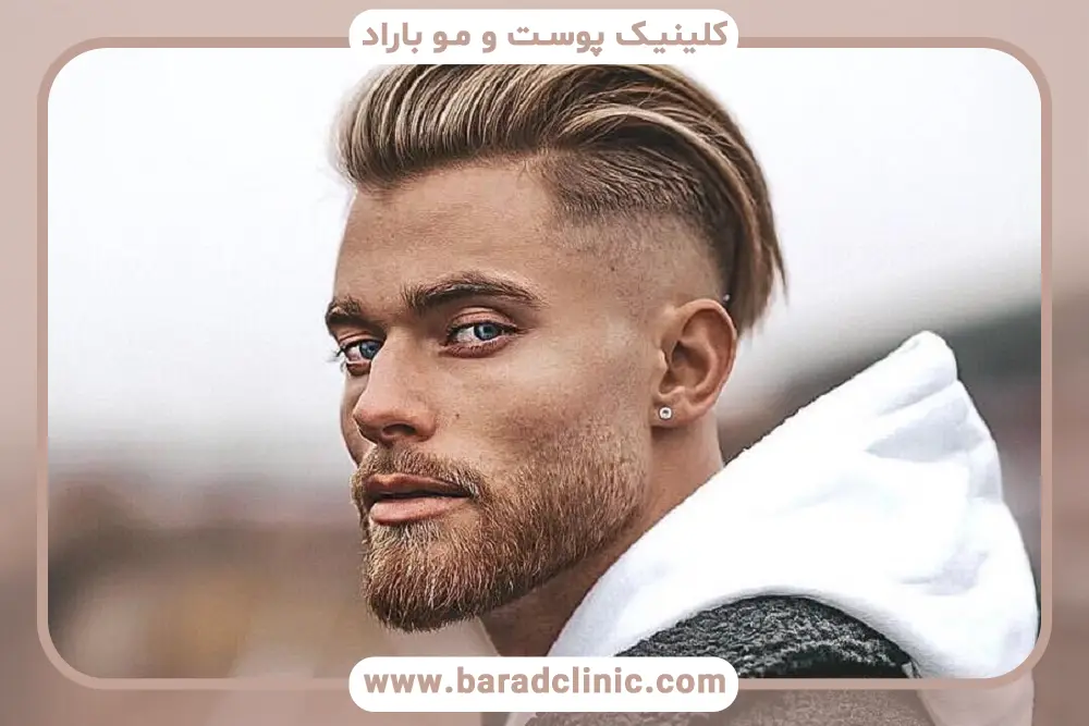 زمان مناسب کاشت مو مجدد 